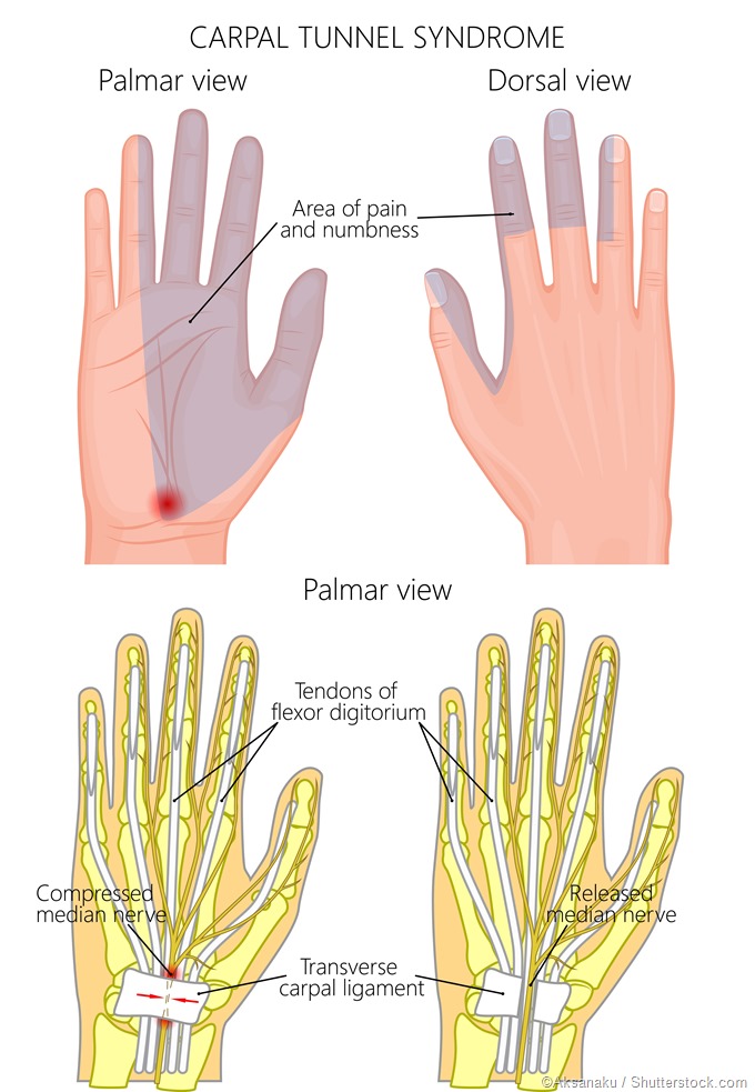 Carpal Tunnel